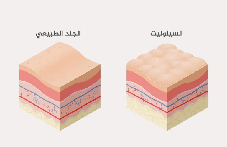 طرق التخلص من السيلوليت والدهون المتراكمة في الجسم نهائيًا